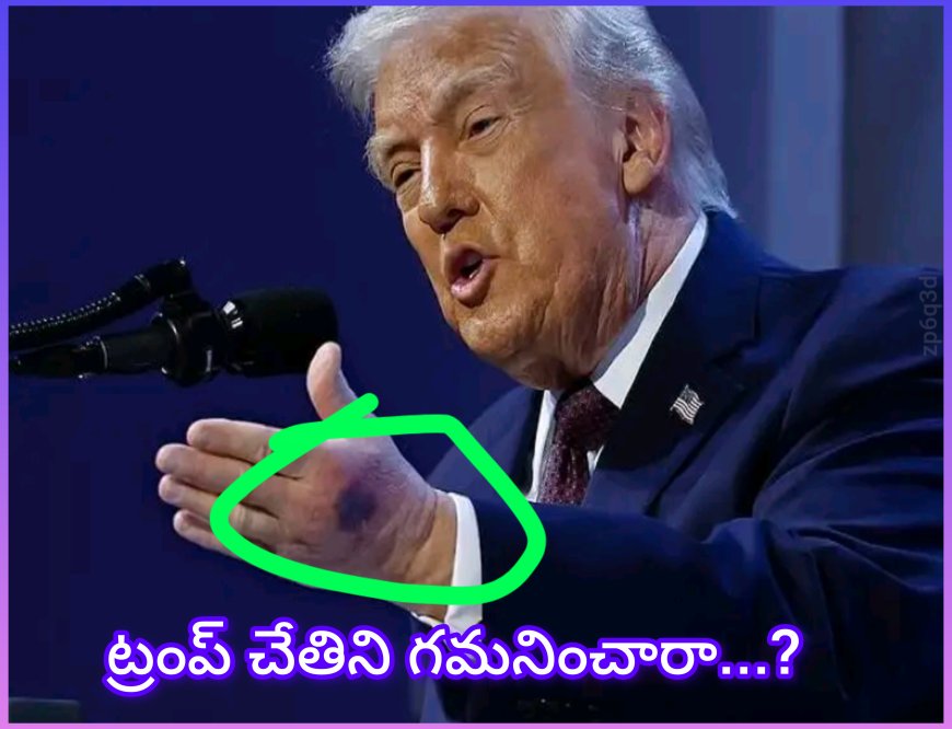 దావోస్ విమాన సమస్య తర్వాత ట్రంప్ చేతిపై గాయం..... ట్రంప్  కి ఏం జరుగుతుంది. ?